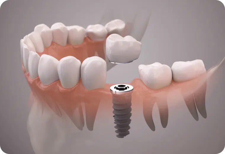 Illustration 3D d'un implant dentaire surmonté d'une couronne