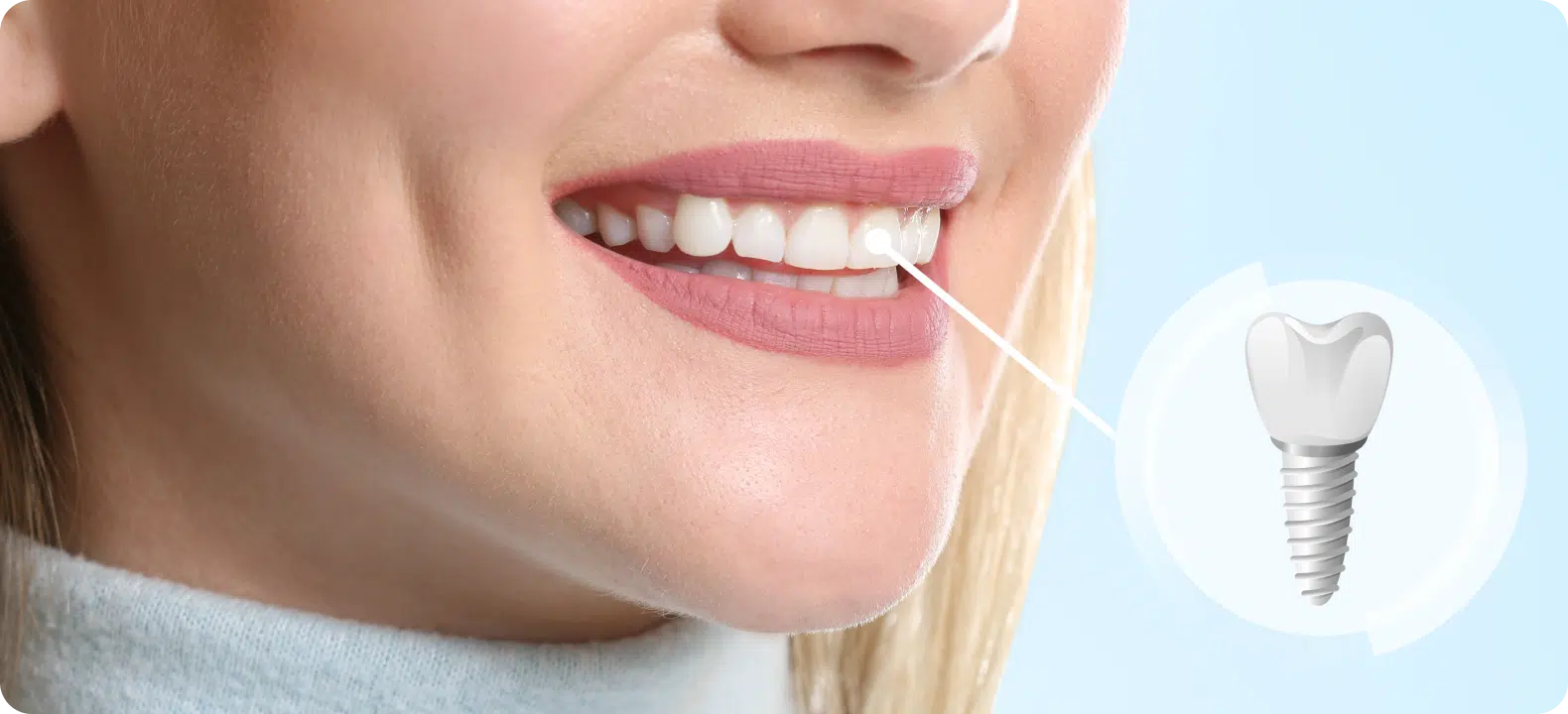 Représentation d'un implant dentaire remplaçant une dent manquante