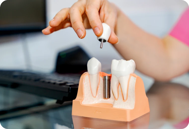 Modèle d'implant dentaire tenu à la main