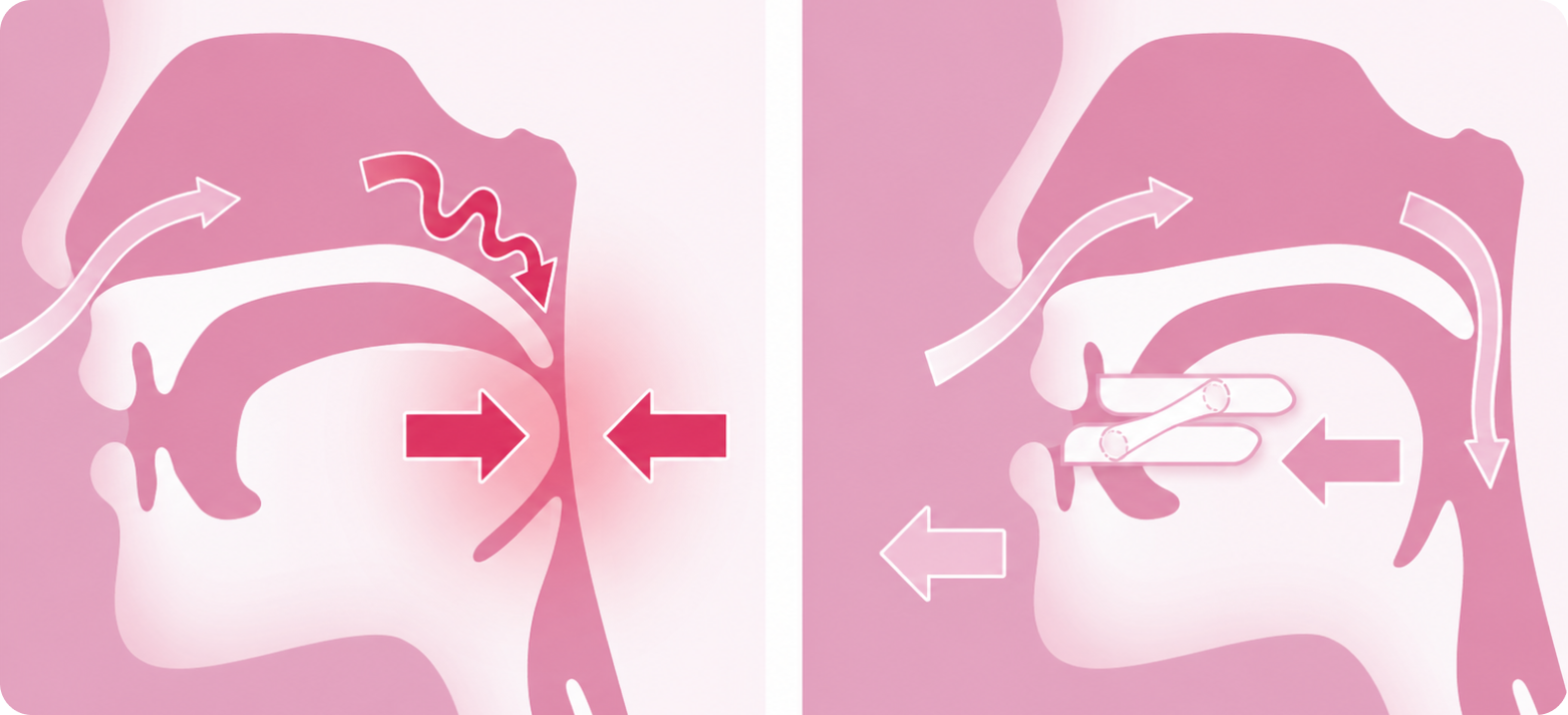 Schéma d’une orthèse d’avancée mandibulaire utilisée pour réduire le ronflement et améliorer la respiration pendant le sommeil.