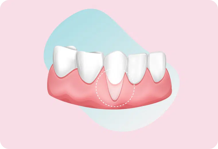 Illustration d'une chirurgie muco-gingivale sur la gencive