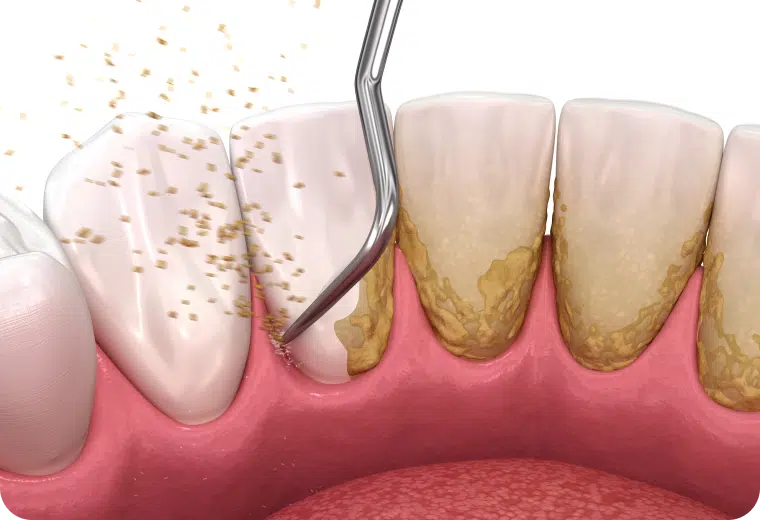 Illustration du détartrage des dents et gencives