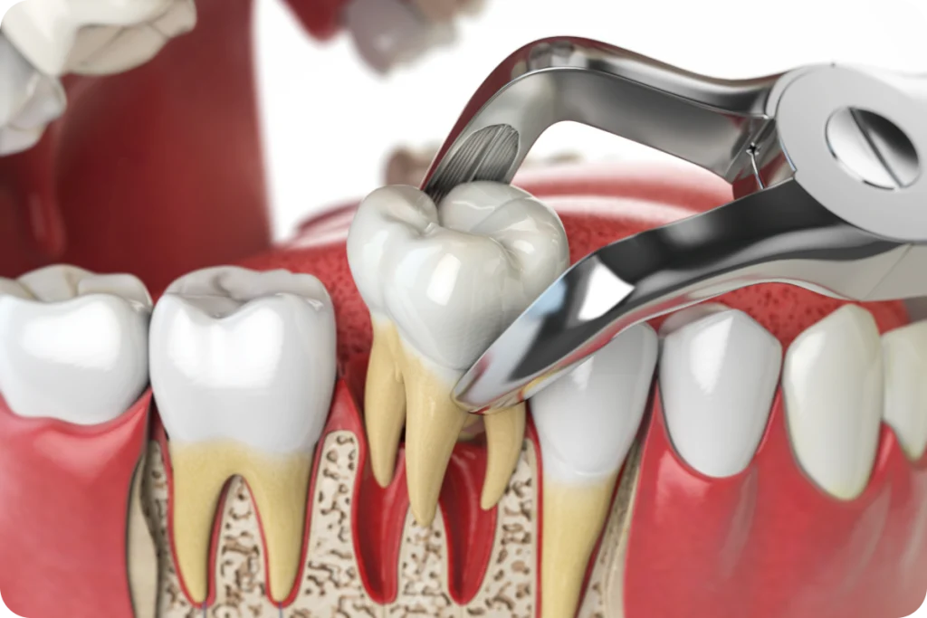 Extraction dentaire avec implantation immédiate à Rambouillet