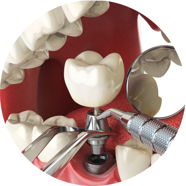 Extraction et implantation immédiate à Rambouillet