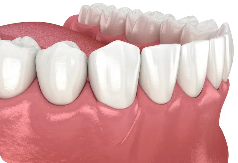 Illustration anatomique d'une gencive saine autour des dents