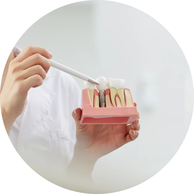 Implant dentaire pour remplacer une dent à Rambouillet