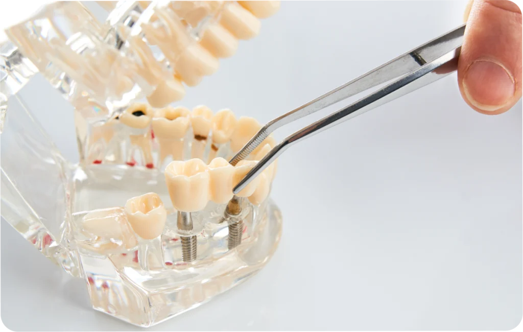 Remplacement de plusieurs dents absentes à Rambouillet